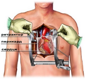 Как проводят стентирование сосудов сердца